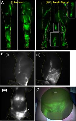 Imaging peripheral lymphatic dysfunction in chronic conditions